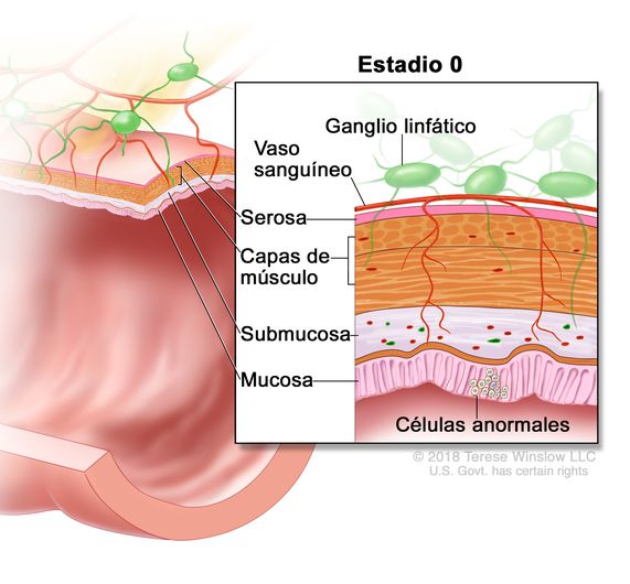 Carcinoma colorrectal in situ en estadio 0. En la imagen se observa un corte transversal del colon o el recto.   En el recuadro se muestran las capas de la pared del colon o el recto y células anormales en la mucosa.   También se muestran la submucosa, las capas de músculo, la serosa, un vaso sanguíneo y ganglios linfáticos.