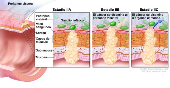 Cáncer colorrectal en estadio II. En la imagen  se observa un corte transversal del colon o el recto, y un recuadro de tres paneles. En cada panel se muestran las capas de la pared del colon o el recto: la mucosa, la submucosa, las capas de músculo y la serosa. También se muestran vasos sanguíneos y ganglios linfáticos. En el primer panel se observa el cáncer en estadio IIA en la mucosa, la submucosa, las capas de músculo y la serosa. En el segundo panel se observa el cáncer en estadio IIB en todas las capas que se disemina a través de la serosa al peritoneo visceral. En el tercer panel se observa el cáncer en estadio IIC que se disemina a órganos cercanos.