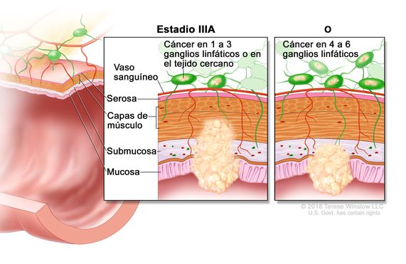 Cáncer colorrectal en estadio IIIA. En la imagen se muestra un corte transversal del recto o el colon y un recuadro de dos paneles. En cada panel se muestran las capas de la pared del colon o el recto: la mucosa, la submucosa, las capas de músculo y la serosa. También se observan vasos sanguíneos y ganglios linfáticos. En el primer panel se observa cáncer en la mucosa, la submucosa, las  capas de músculo y en dos ganglios linfáticos. En el segundo panel se observa cáncer en la mucosa, la submucosa y en cinco ganglios linfáticos.