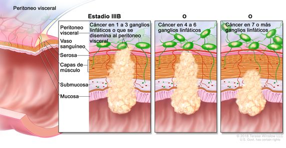Cáncer colorrectal en estadio IIIB. En la imagen se muestra un corte transversal del colon o el recto y un recuadro de tres paneles. En cada panel se muestran las capas de la pared del colon o el recto:  la mucosa, la submucosa, las capas de músculo y la serosa. También se muestran vasos sanguíneos y ganglios linfáticos. En el primer panel se observa cáncer en todas las capas, en tres ganglios linfáticos y en el peritoneo visceral. En el segundo panel se  observa cáncer en todas las capas y en cinco ganglios linfáticos cercanos. En el tercer panel se observa cáncer en la mucosa, la submucosa, las capas de músculo y en siete ganglios linfáticos.