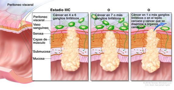 Cáncer colorrectal en estadio IIIC. En la imagen se muestran un corte transversal de la pared del colon o el recto y un recuadro de tres paneles. En cada panel se muestran las capas de la pared del  colon o el recto: la mucosa, la submucosa, las capas de músculo y la serosa. También se muestran vasos sanguíneos y ganglios linfáticos. En el primer panel se observa cáncer en todas las capas, en cuatro ganglios linfáticos y en el peritoneo visceral. En el segundo panel se observa cáncer en todas las capas y en siete ganglios linfáticos. En el tercer panel se observa cáncer en todas las capas, en dos ganglios linfáticos y que se disemina a órganos cercanos.