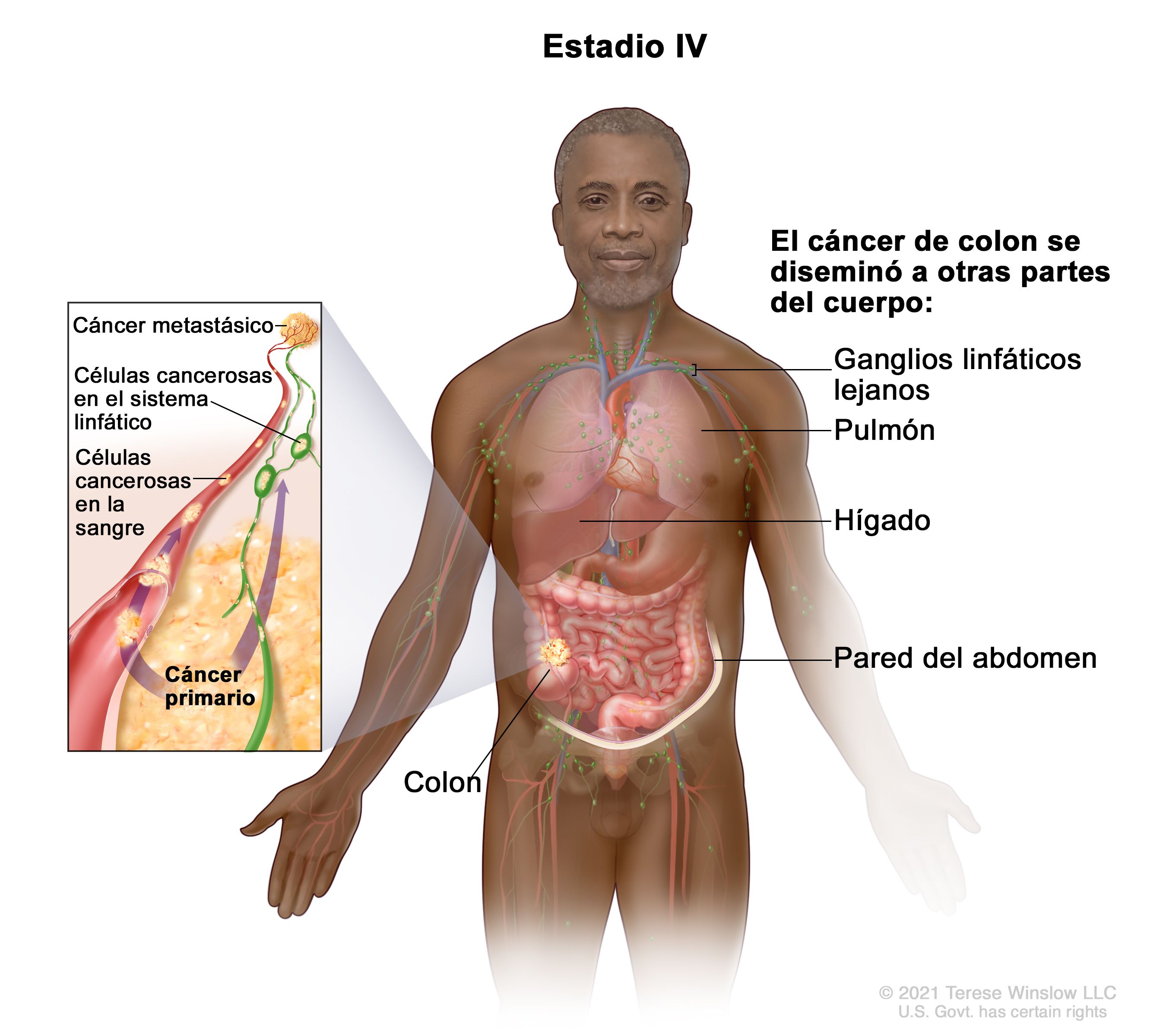 Cancer de colon fases, - Cancer de colon etapas y sintomas