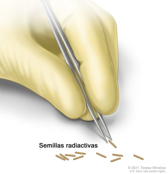 Semillas radiactivas; el dibujo muestra una mano enguantada usando un instrumento para recoger semillas radiactivas pequeñas.