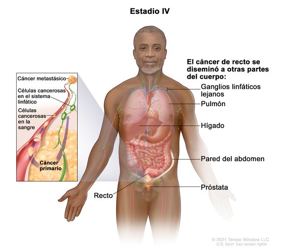 Haideti sa-l ajutam pe Rosu Cancer de colon higado