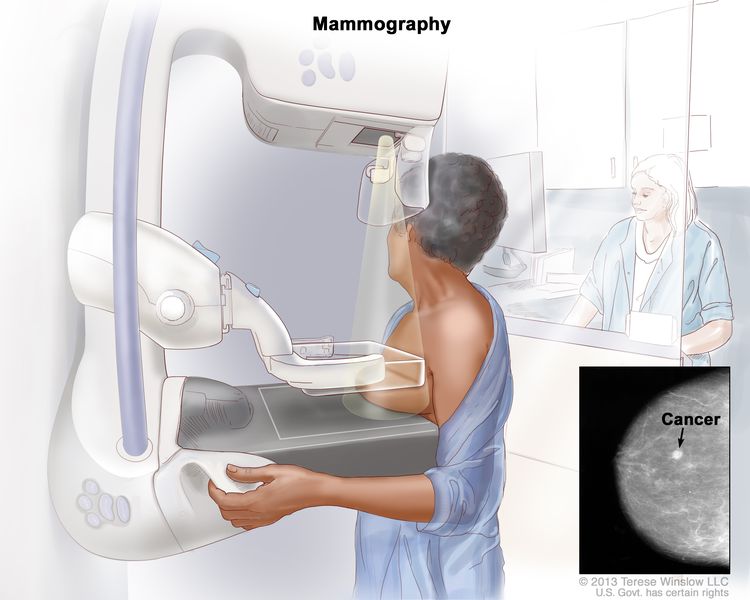 تصوير الثدي الشعاعي. يتم ضغط الثدي الأيسر بين لوحين. يتم استخدام جهاز الأشعة السينية لالتقاط صور للثدي. يُظهر الشكل الداخلي صورة فيلم الأشعة السينية مع سهم يشير إلى نسيج غير طبيعي.