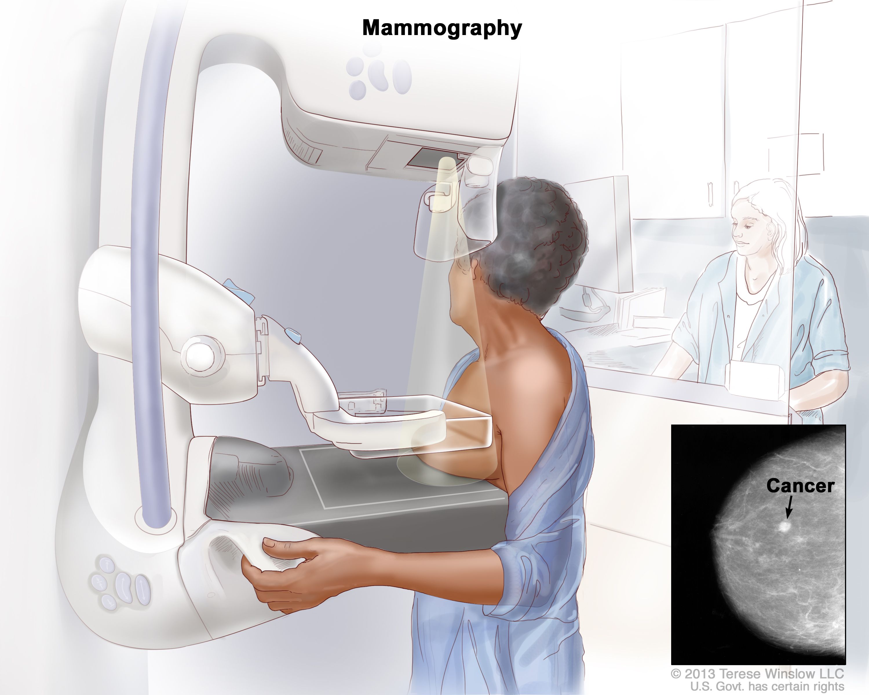 Self-referral mammograms for breast screening