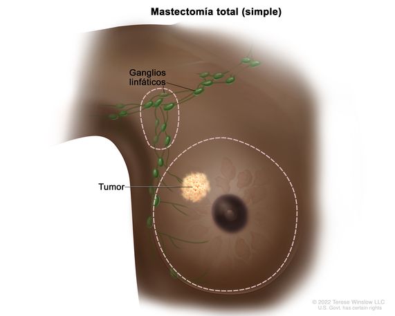 Mastectomía total (simple). En el dibujo se señalan con líneas punteadas las zonas que se extirparán: la mama completa que incluye un tumor y algunos de los ganglios linfáticos de la axila.