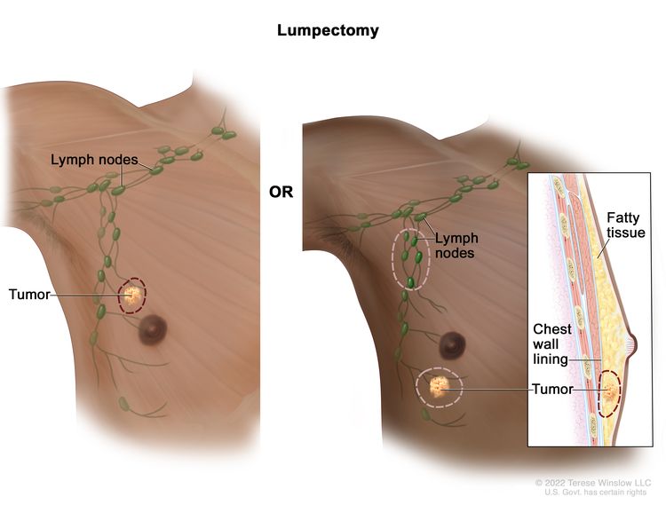 Breast-conserving surgery; the drawing on the left shows removal of the tumor and some of the normal tissue around it. The drawing on the right shows removal of some of the lymph nodes under the arm and removal of the tumor and part of the chest wall lining near the tumor. Also shown is fatty tissue in the breast.