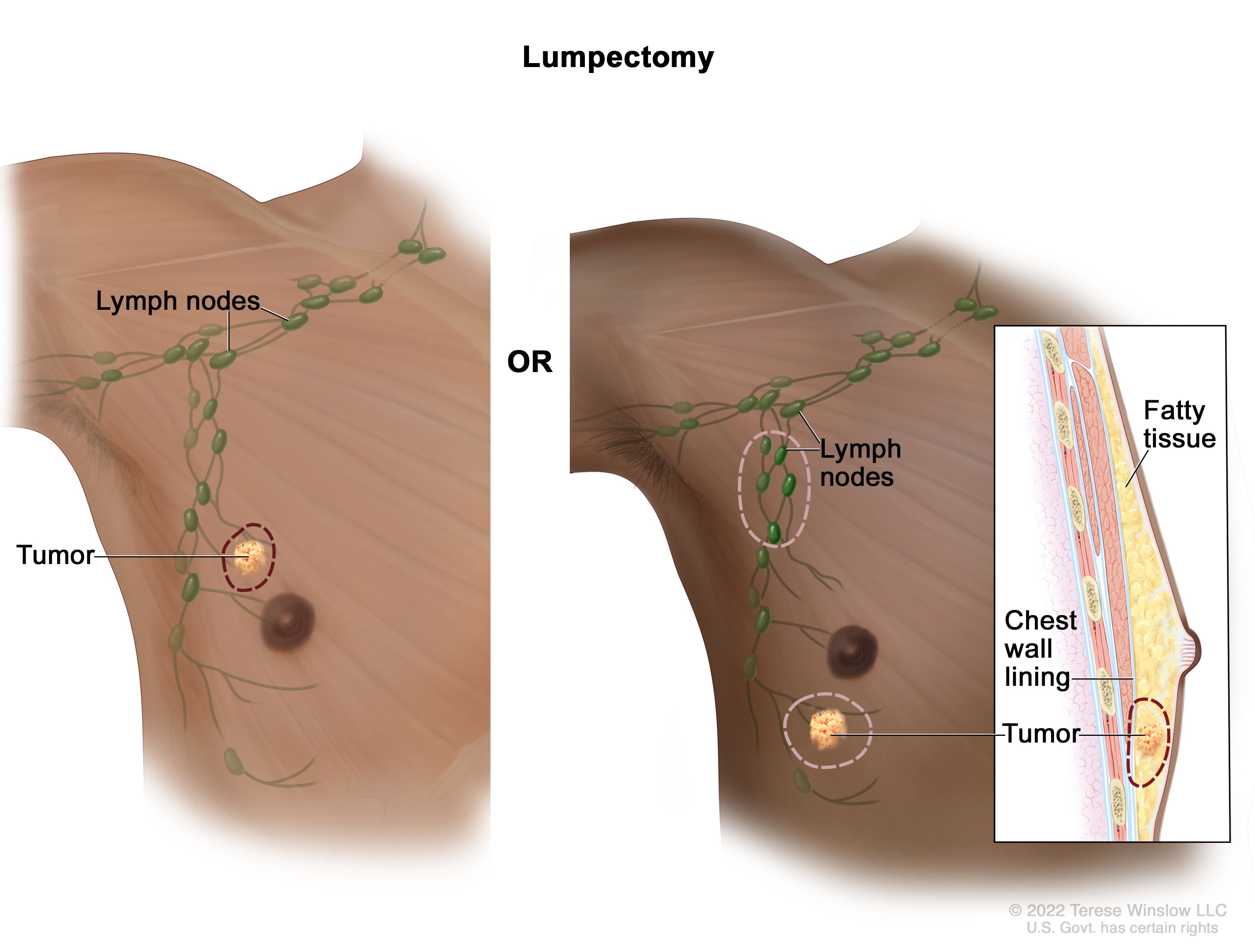 Male Breast Cancer Treatment NCI