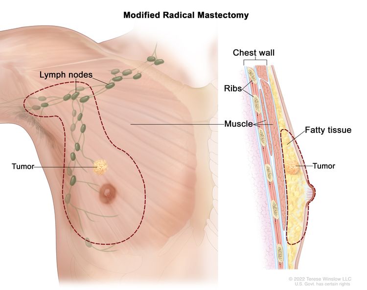 استئصال الثدي الجذري المعدل يوضح الرسم الموجود على اليسار إزالة الثدي بالكامل ، بما في ذلك العقد الليمفاوية الموجودة أسفل الذراع. يُظهر الرسم الموجود على اليمين مقطعًا عرضيًا للثدي ، بما في ذلك الأنسجة الدهنية وجدار الصدر (الضلوع والعضلات). يظهر ورم أيضًا في الثدي.