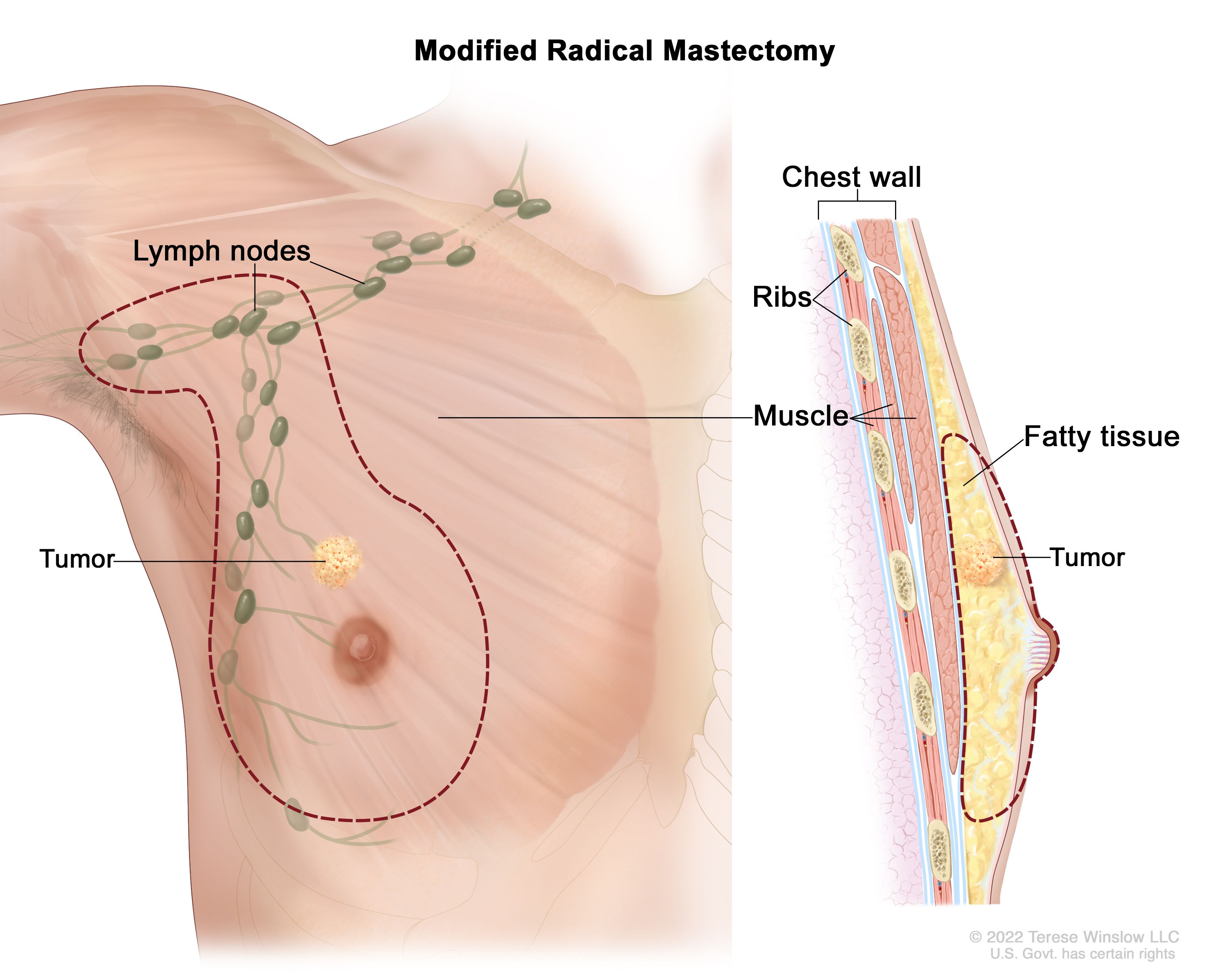 Breast Tissue Anatomy; Tissue and Lymph Node Examination