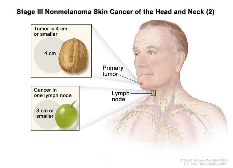 Stage III nemelanomski kožni rak glave in vratu (2);  risba prikazuje primarni tumor na obrazu in rak v enem bezgavki na isti strani telesa kot tumor.  Zgornji vložek kaže, da je tumor 4 centimetre ali manj in da je 4 centimetra velikost oreha.  Spodnji vložek kaže, da je bezgavka z rakom 3 centimetre ali manj in da je 3 centimetre približno velikost grozdja.