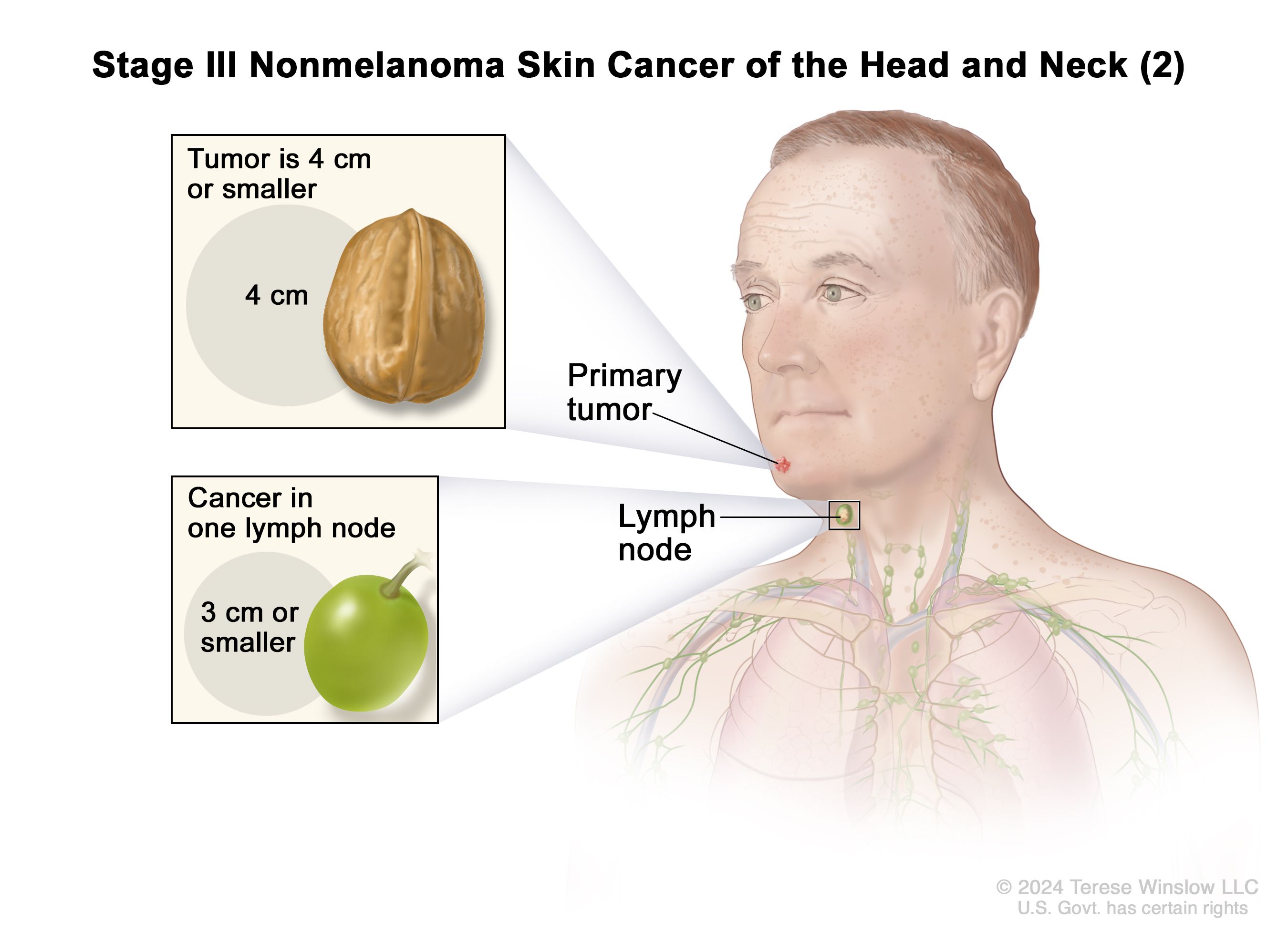 Early Stage Cancer Lymph Nodes In Neck Symptoms Mammograms Covid