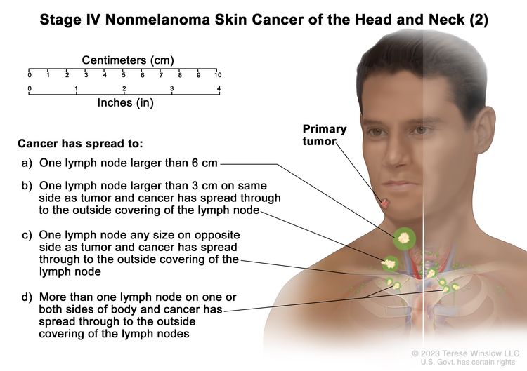 Stage IV nonmelanoma skin cancer of the head and neck (2); drawing shows a primary skin tumor on the face and cancer that has spread to: (a) one lymph node that is larger than 6 centimeters; (b) one lymph node on the same side of the body as the tumor, the affected node is larger than 3 centimeters, and cancer has spread through to the outside covering of the lymph node; (c) one lymph node on the opposite side of the body as the tumor, the affected node is any size, and cancer has spread through to the outside covering of the lymph node; and (d) more than one lymph node on one or both sides of the body and cancer has spread through to the outside covering of the lymph nodes. Also shown is a 10-centimeter ruler and a 4-inch ruler.