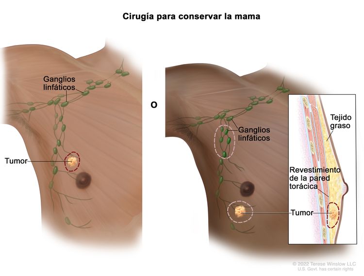 Cirugía para conservar la mama; el dibujo muestra la extirpación del tumor y los ganglios linfáticos axilares.