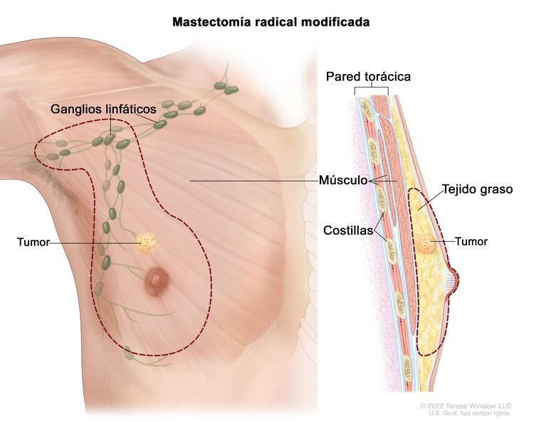 Mastectomía radical modificada. En el dibujo se señalan con líneas punteadas las zonas que se extirparán durante una mastectomía radical modificada. A la izquierda se muestra la vista frontal de la mama y se señala toda la mama, un tumor y los ganglios linfáticos de la axila que se extirparán. A la derecha se muestra la vista lateral de la mama y se señala la pared torácica, dos costillas y varios músculos, además del tumor que se extirpará junto con una parte del tejido graso.