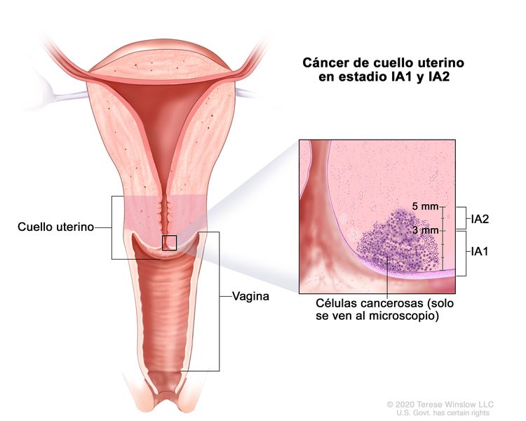 Cáncer de cuello uterino en estadios IA1 y IA2. En la imagen se observa un corte transversal del cuello uterino y la vagina. En el recuadro se muestran células cancerosas en el cuello uterino que solo se observan al microscopio. En el estadio IA1 el tumor se diseminó a una profundidad de 3 mm o menos. En el estadio IA2 el tumor se diseminó a una profundidad de más de 3 mm, pero no más de 5 mm.