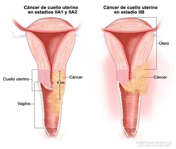 cáncer de útero