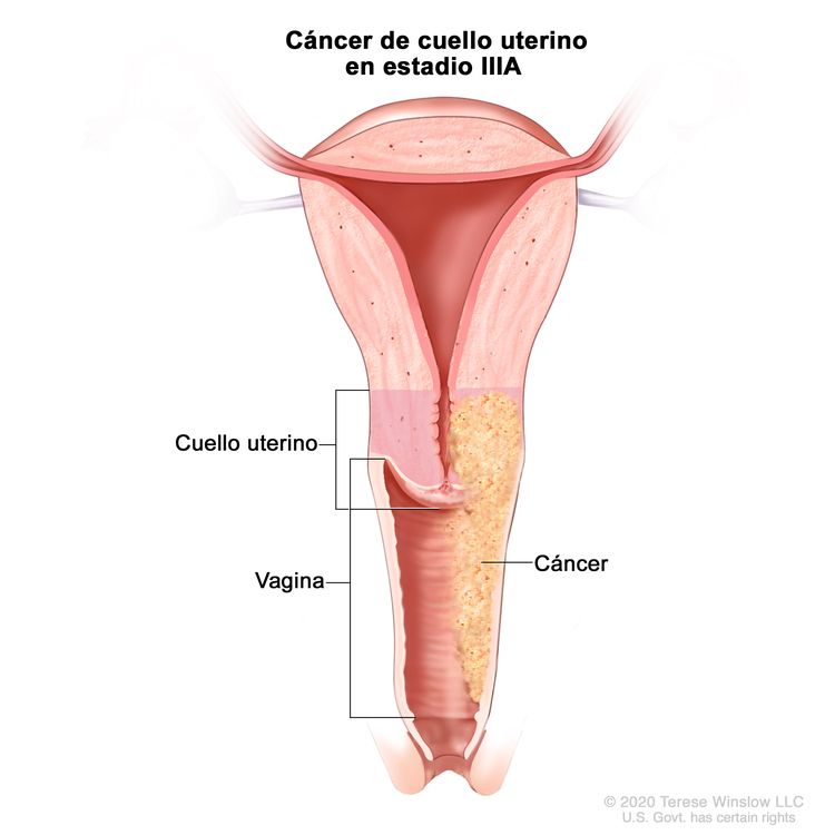 Cáncer de cuello uterino en estadio IIIA. En la imagen se observa un corte transversal del cuello uterino y la vagina. Se muestra cáncer en el cuello uterino y a todo lo largo de la vagina.
