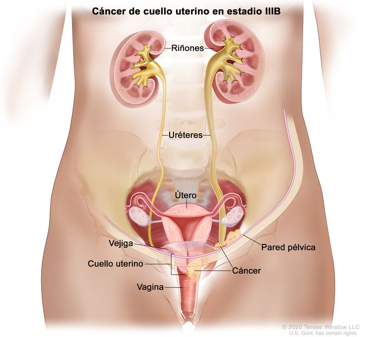 Cáncer de cuello uterino en estadio IIIB. En la imagen se observa cáncer en el cuello uterino y la pared pélvica. También se muestra cáncer que obstruye el uréter derecho, y agrandamiento del uréter y el riñón derechos. Además, se observan el útero, la vejiga y la vagina.