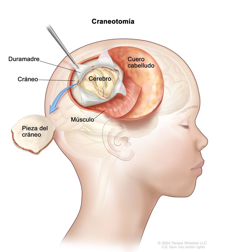 En el dibujo de la cabeza de un niño se muestra una craneotomía, es decir, un orificio en el cráneo. Se observa que se levantó una sección del cuero cabelludo para extraer una pieza del cráneo. Se abrió la duramadre que cubre el encéfalo para exponer la superficie del cerebro. También se señala la capa de músculo debajo del cuero cabelludo.
