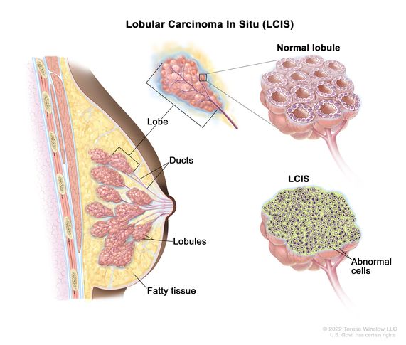 Lobular carcinoma in situ (LCIS); drawing shows a lobe, ducts, lobules, and fatty tissue in a cross section of the breast. Three separate pullouts show a normal lobe, a normal lobule, and a lobule with abnormal cells.