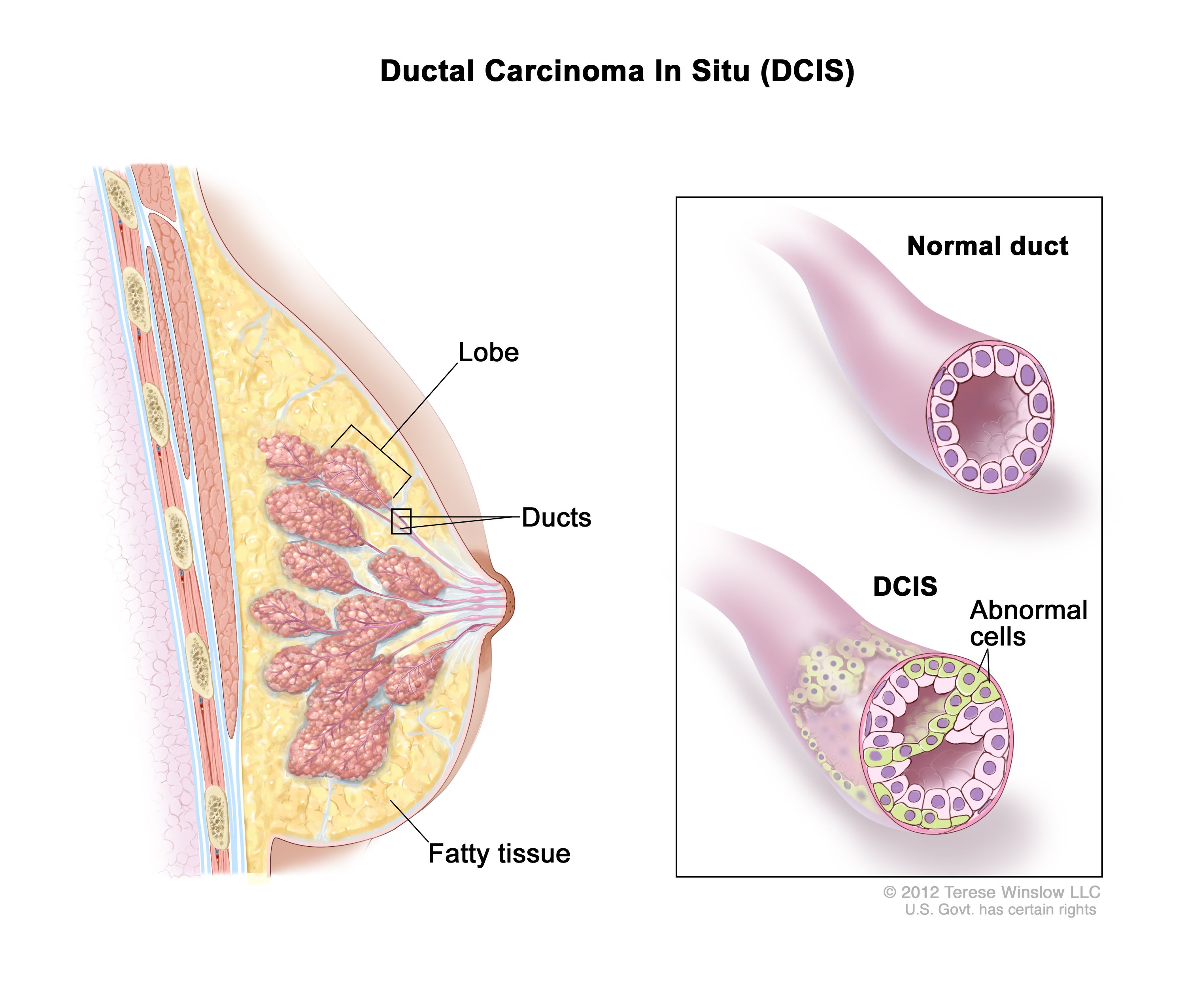 Definition of intraductal breast carcinoma - NCI Dictionary of