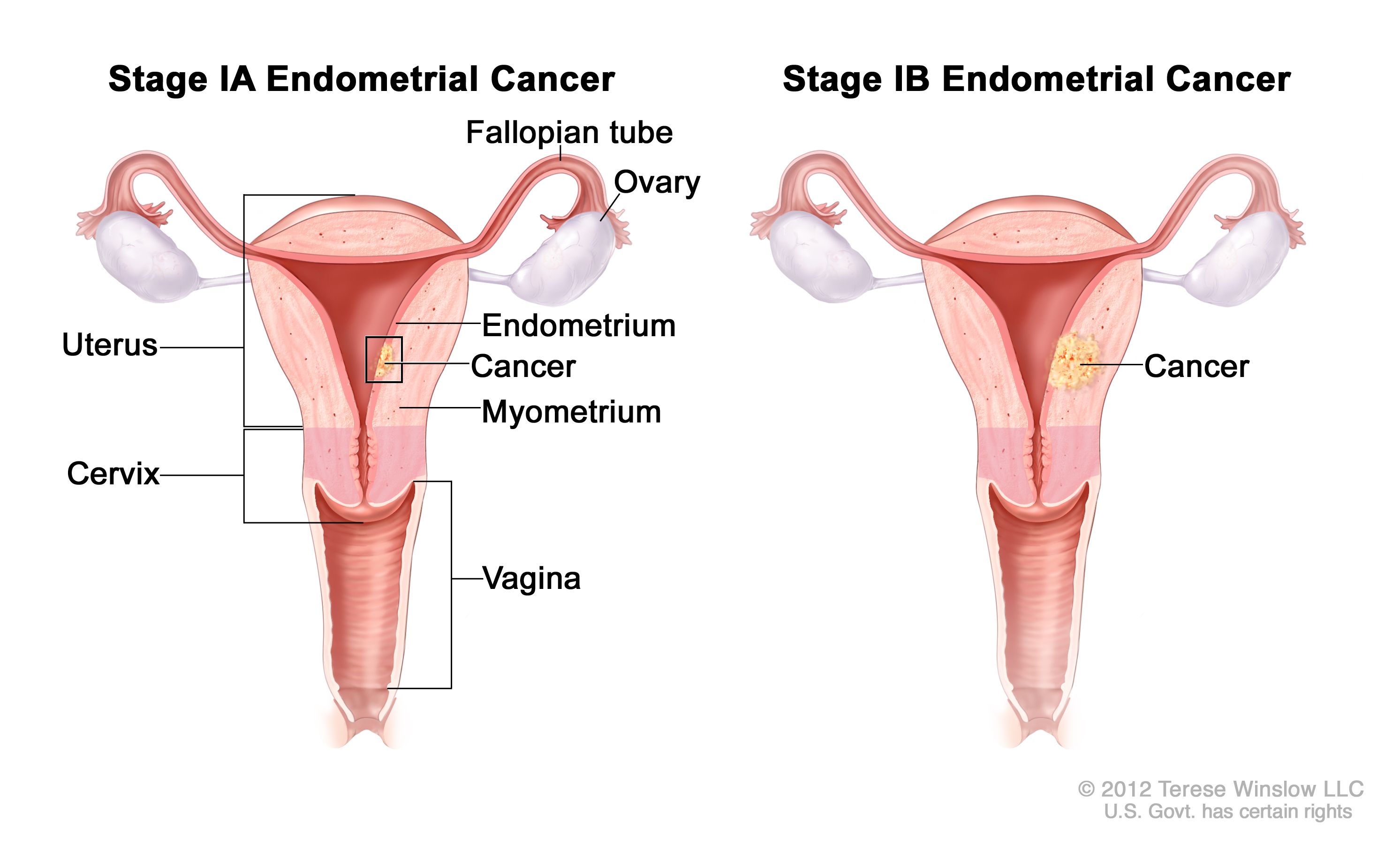 endometrial cancer recurrence symptoms)