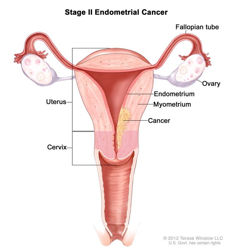 Stage II endometrial cancer shown in a cross-section drawing of the uterus, cervix, fallopian tubes, ovaries, and vagina. Cancer is shown in the endometrium and myometrium of the uterus and in the cervix.
