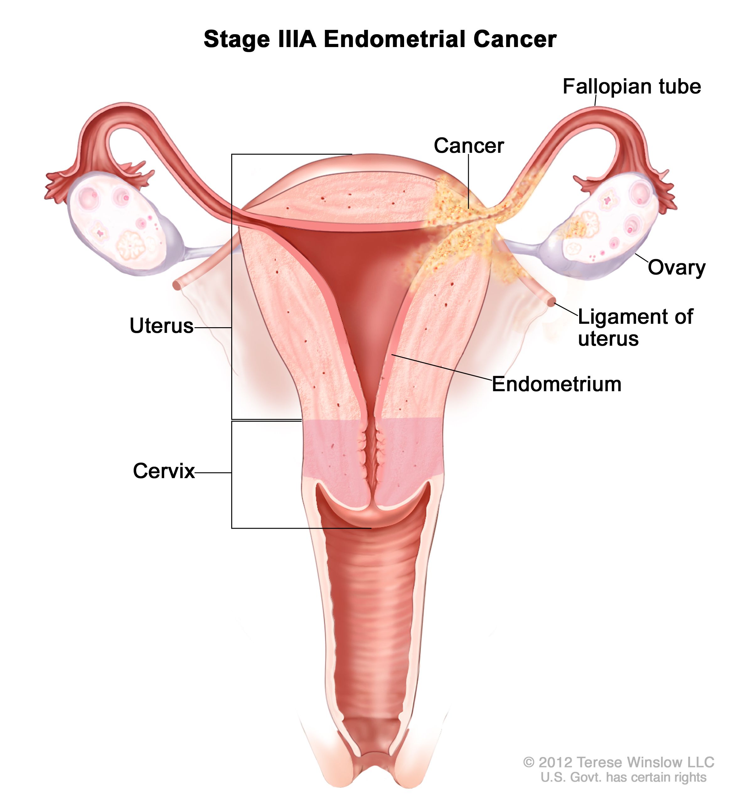 endometrium rák tumor markerek a férgek megelőzése és kezelése terhesség alatt