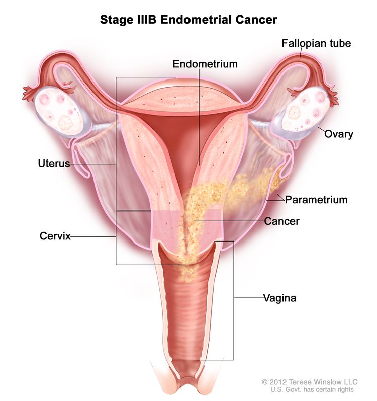 Stage IIIB endometrial cancer shown in a cross-section drawing of the uterus, cervix, fallopian tubes, ovaries, and vagina. Cancer is shown in the endometrium of the uterus, the parametrium, the cervix, and the vagina.