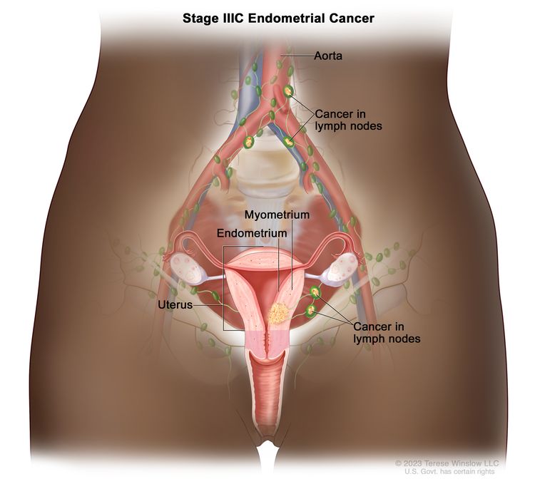 Stage IIIC endometrial cancer shown in a cross-section drawing of the uterus, cervix, fallopian tubes, ovaries, and vagina. Also shown are the lymph nodes in the pelvis and the aorta with nearby lymph nodes. Cancer is shown in the endometrium and myometrium of the uterus and in lymph nodes in the pelvis and near the aorta.
