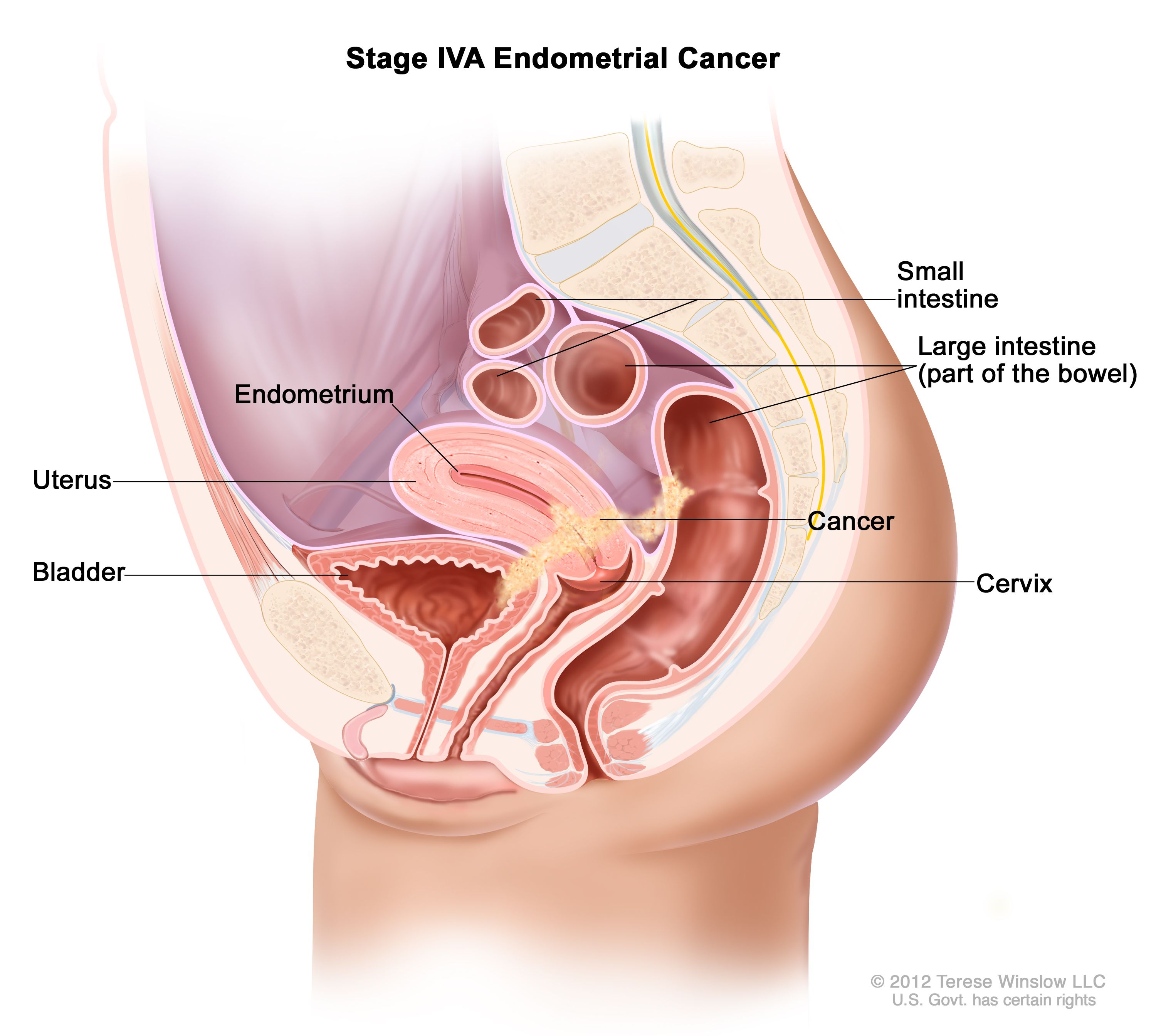 Endometrial Cancer Treatment (PDQ®) - NCI