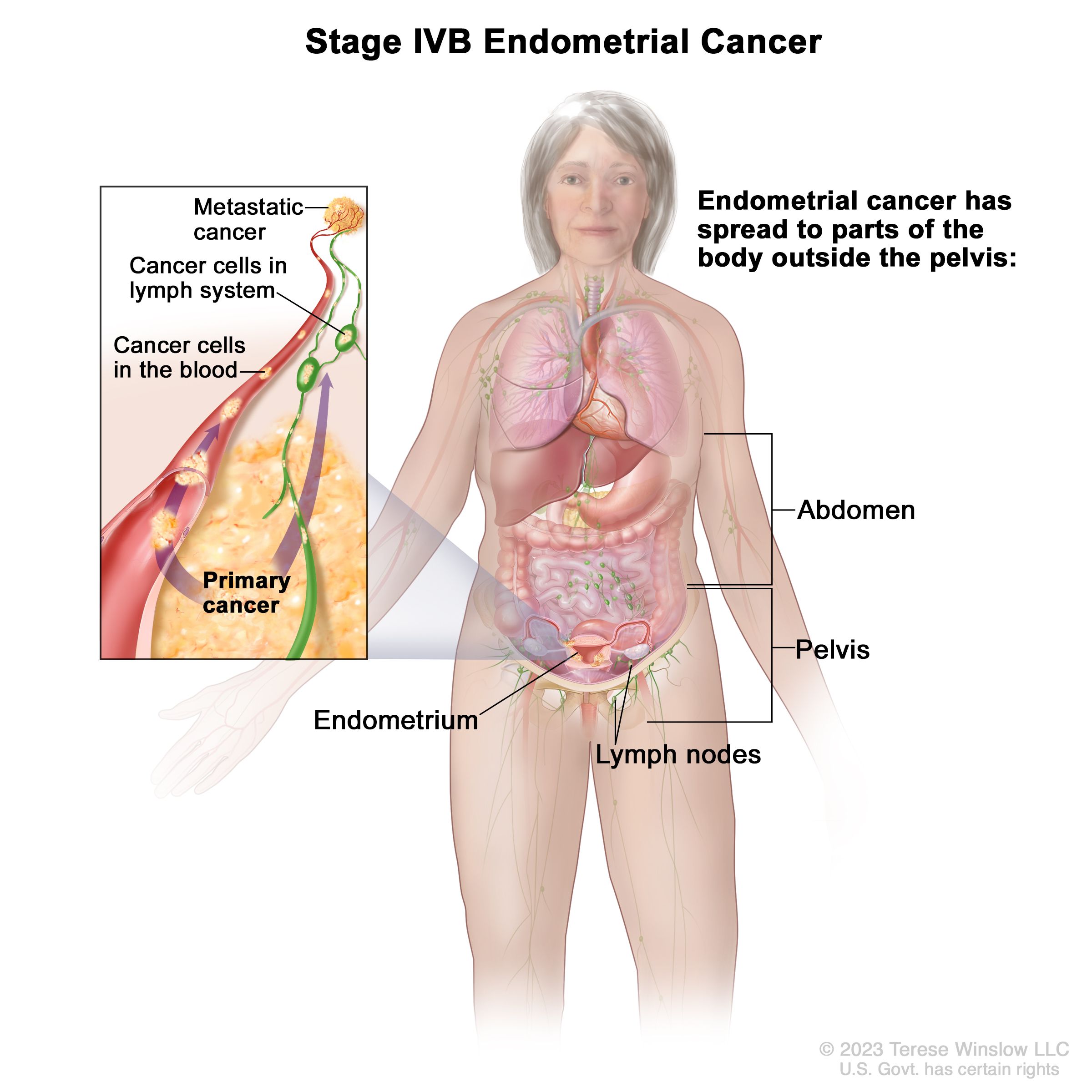 endometrial cancer how fast does it spread)