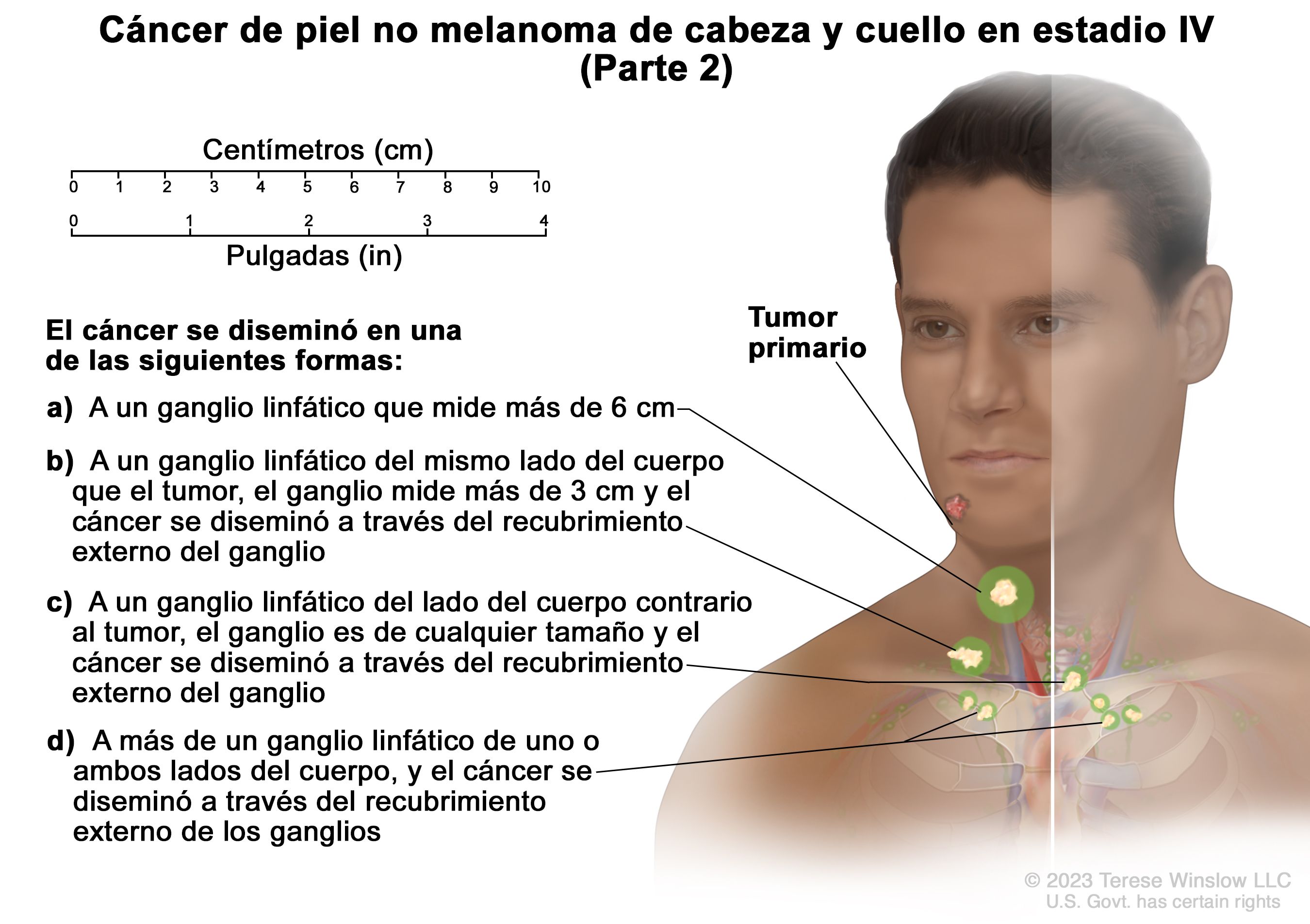 Tratamiento Del Cáncer De Piel Pdq®versión Para Profesionales De Salud Nci 0674