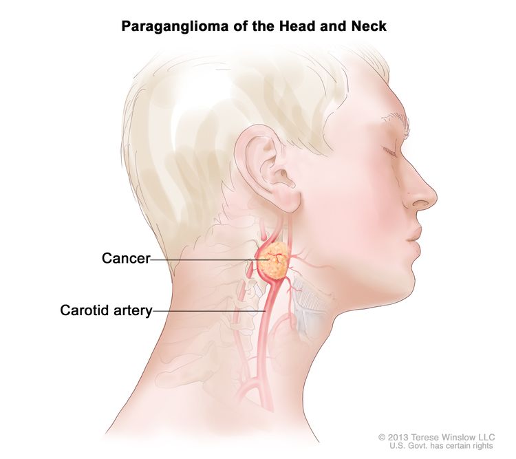 Paraganglioma of the head and neck; drawing shows a tumor near the carotid artery in the head and neck.