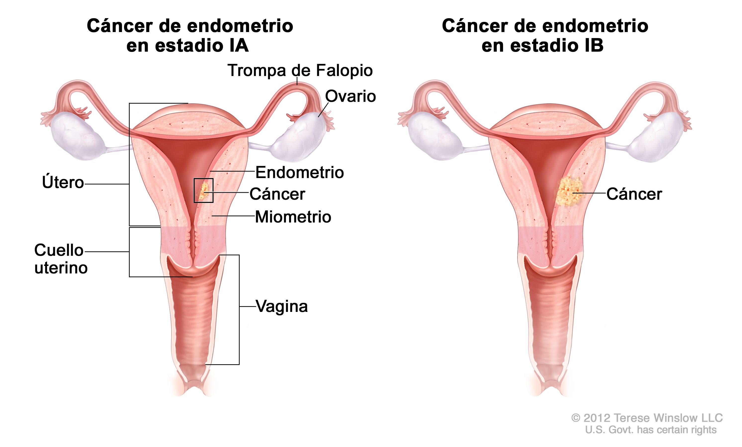 cancer endometrial pronostico