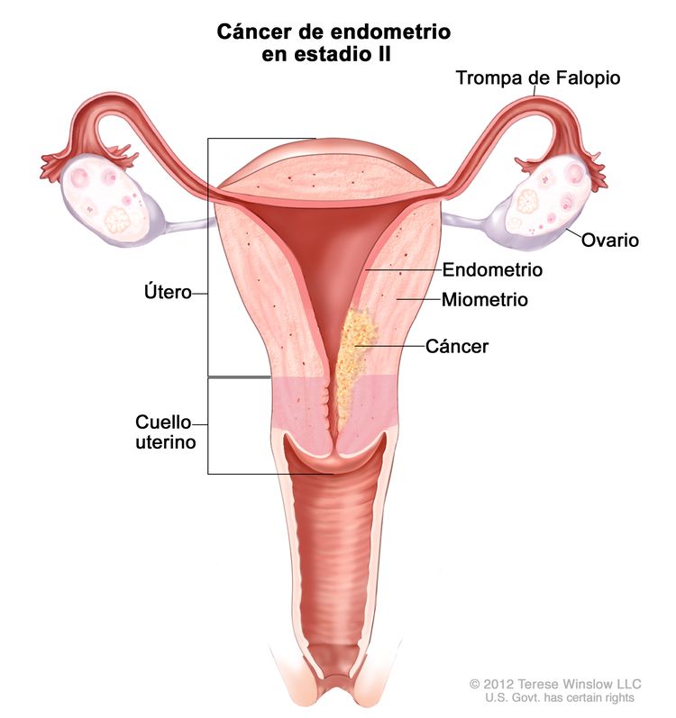 El dibujo muestra un cáncer de endometrio en estadio II en una sección transversal del útero, el cuello uterino, las trompas de Falopio, los ovarios y la vagina. Se muestra el cáncer en el endometrio y el miometrio del útero, y en el cuello uterino.