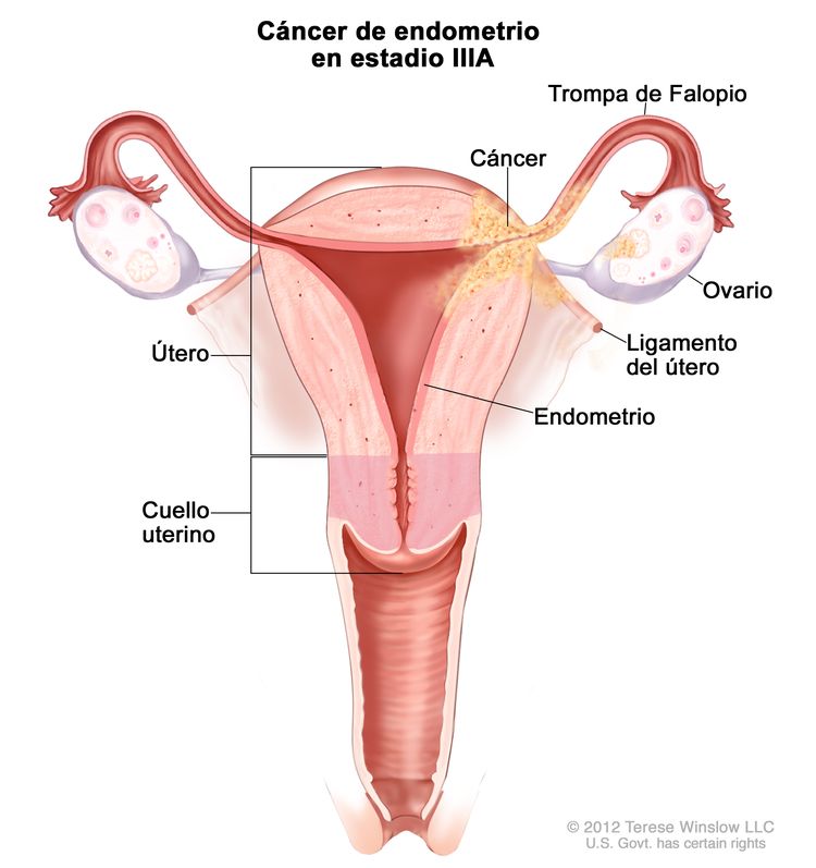 El dibujo muestra un cáncer de endometrio en estadio IIIA en una sección transversal del útero, los ligamentos del útero, el cuello uterino, las trompas de Falopio, los ovarios y la vagina. Se muestra el cáncer en el endometrio del útero, la capa exterior del útero, una trompa de Falopio, un ovario y un ligamento del útero.