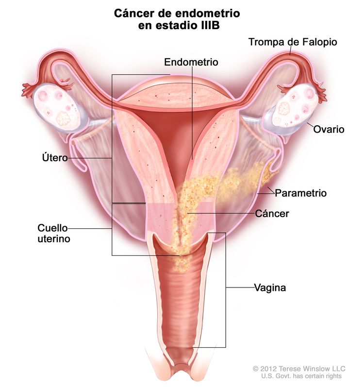El dibujo muestra un cáncer de endometrio en estadio IIIB en una sección transversal del útero, el cuello uterino, las trompas de Falopio, los ovarios y la vagina. Se muestra el cáncer en el endometrio del útero, el parametrio, el cuello uterino y la vagina.