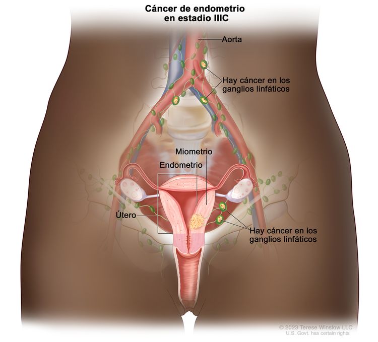 Cáncer de endometrio en estadio IIIC. En el dibujo se muestra cáncer en el endometrio y el miometrio del útero. También se observa cáncer en los ganglios linfáticos de la pelvis y en los que están cerca de la aorta.