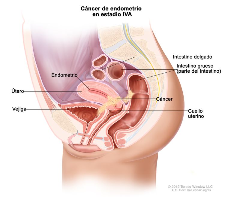 El dibujo muestra un cáncer de endometrio en estadio IVA en una sección transversal lateral del útero, la vejiga, el cuello uterino, la vagina, el intestino delgado y el intestino grueso. Se muestra el cáncer en la vejiga, el útero y los intestinos.