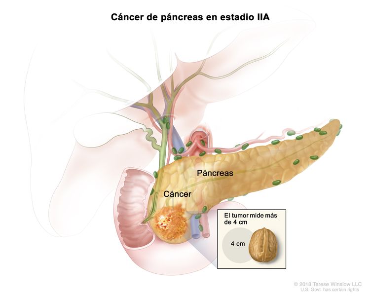 Cáncer de páncreas en estadio llA; en la imagen, se observa el cáncer en el páncreas y el tumor mide más de 4 cm. En el recuadro, se observa que 4 cm es casi el tamaño de una nuez.