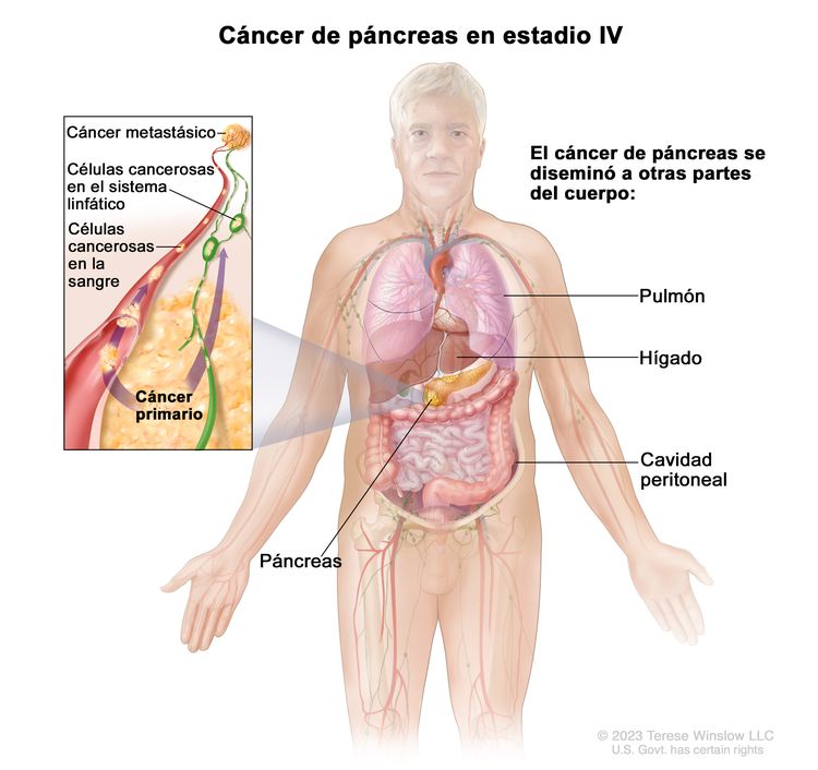 Cáncer de páncreas en estadio lV; en el dibujo se observan otras partes del cuerpo adonde el cáncer de páncreas se puede diseminar, como el pulmón, el hígado y la cavidad peritoneal. En el recuadro se observan las células cancerosas que se diseminan desde el páncreas, a través de la sangre y el sistema linfático, a otra parte del cuerpo donde se formó el cáncer metastásico.