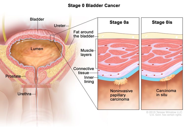 Stage 0 bladder cancer; drawing shows the bladder, ureter, prostate, and urethra. First inset shows stage 0a (also called noninvasive papillary carcinoma) on the inner lining of the bladder. Second inset shows stage 0is (also called carcinoma in situ) on the inner lining of the bladder. Also shown are the layers of connective tissue and muscle tissue of the bladder and the layer of fat around the bladder.