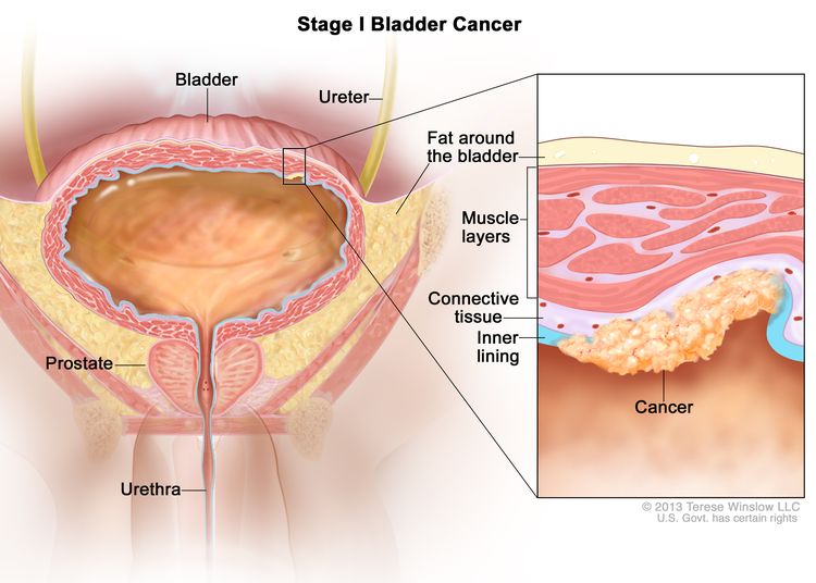 Stage I bladder cancer; drawing shows the bladder, ureter, prostate, and urethra. Inset shows cancer in the inner lining of the bladder and in the layer of connective tissue next to it. Also shown are the muscle layers of the bladder and the layer of fat around the bladder.