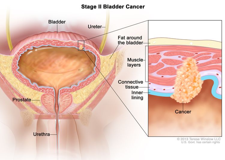 Stage II bladder cancer (muscle-invasive bladder cancer); drawing shows the bladder, ureter, prostate, and urethra. An inset shows cancer in the inner lining of the bladder and in the layer of connective tissue and the muscle layers of the bladder. Also shown is the layer of fat around the bladder.