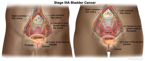 Definition Of Stage Iii Bladder Cancer Nci Dictionary Of Cancer Terms Nci 1201