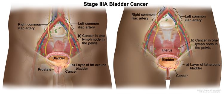 Two-panel drawing showing stage IIIA bladder cancer in a male (left panel) and a female (right panel); both panels show cancer in the bladder and in (a) the layer of fat around the bladder and (b) one lymph node in the pelvis. Also shown are the right and left common iliac arteries, the prostate (left panel), and the uterus (right panel).