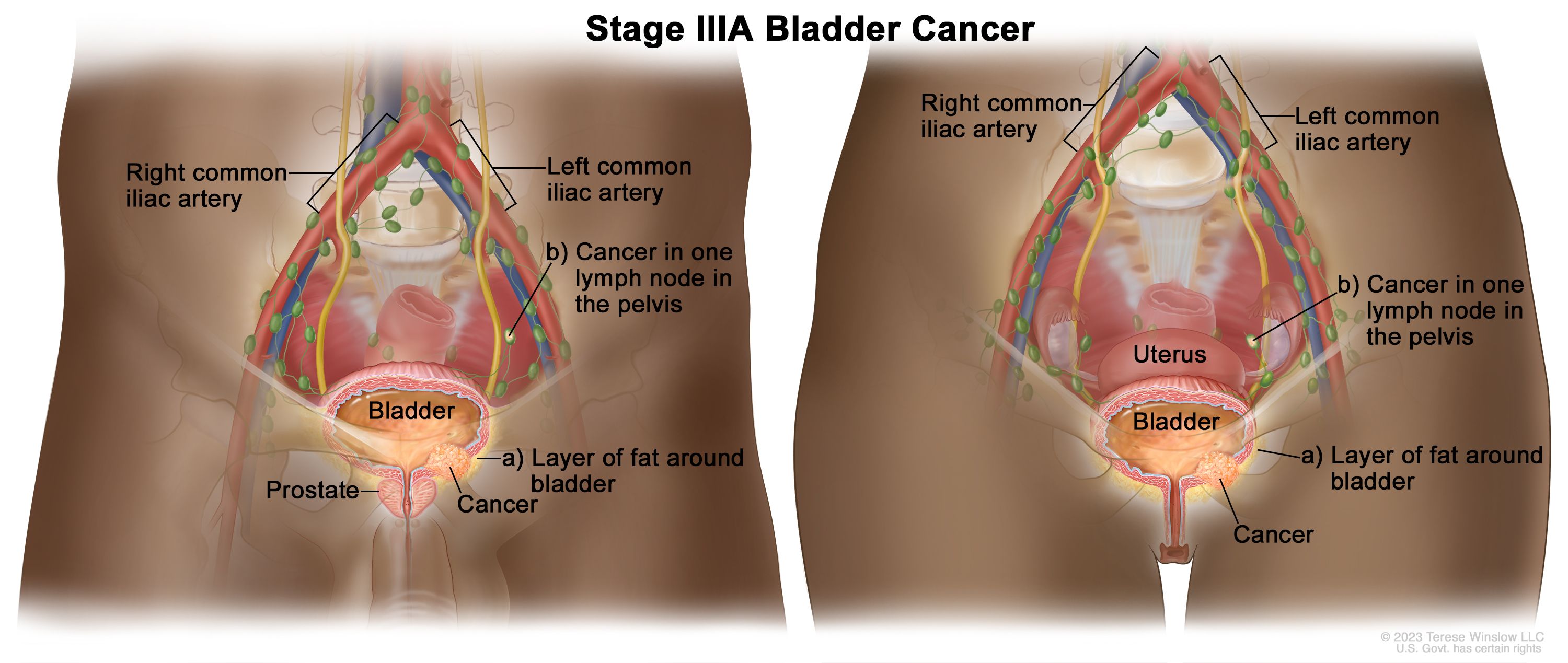 Vaiheen IIIA virtsarakon syöpä